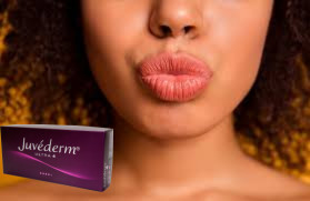 Juvederm Ultra 3 Ultra 4 relleno de ácido hialurónico para mejorar los labios