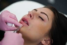 GMP Juvederm Ultra 3 HA Relleno dérmico para labios Juvederm Vollure
